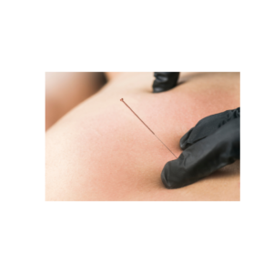 Dry needling Amsterdam